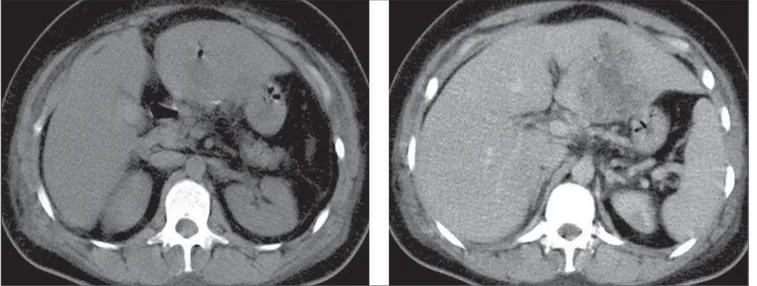 Figure 1. Abdominal computed tomography before and after intravenous contrast injection.