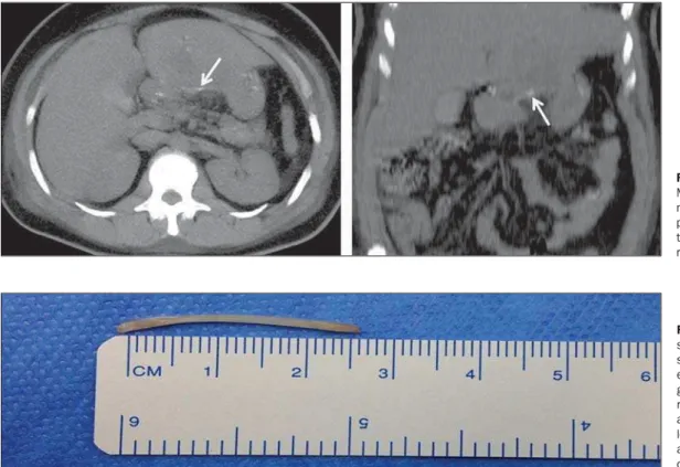 Figure 1. A: Predominantly hypodense, expansile, loculated mass with anfractuous contours, measuring 8.1 cm × 6.2 cm,  pre-senting peripheral, heterogeneous contrast enhancement, located in the left hepatic lobe (segments II and III)