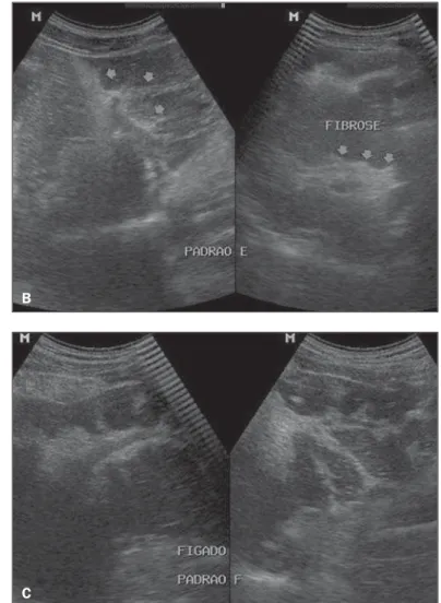 Figure 1 shows some imaging patterns observed in the studied patients, where the qualitative aspect of the hepatic  paren-chyma and the IP score are analyzed  ac-cording to the Niamey Working Group  pro-tocol (9) .