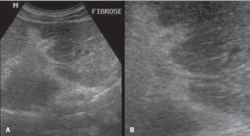 Figure 3. Sonographic images demonstrating the PH score. Presence of collateral circulation, visualized at color Doppler mapping (A) and at B mode (B).