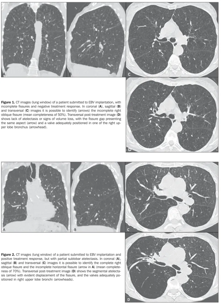 Figure 2. CT images (lung window) of a patient submitted to EBV implantation and positive treatment response, but with partial sublobar atelectasis