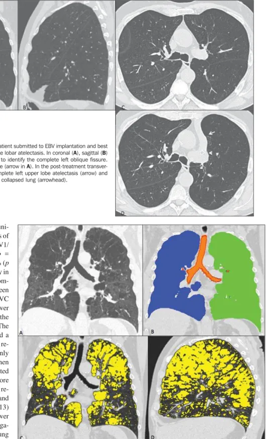 Figure 3. CT images (lung window) of a patient submitted to EBV implantation and best positive treatment response, with complete lobar atelectasis