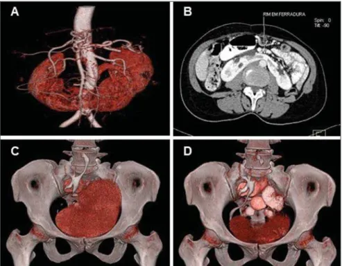 Figure 1. Renal shape abnormalities. MDCT image with VRT (A) and axial view (B) of a “horseshoe” kid- kid-ney showing the connection between the inferior renal poles