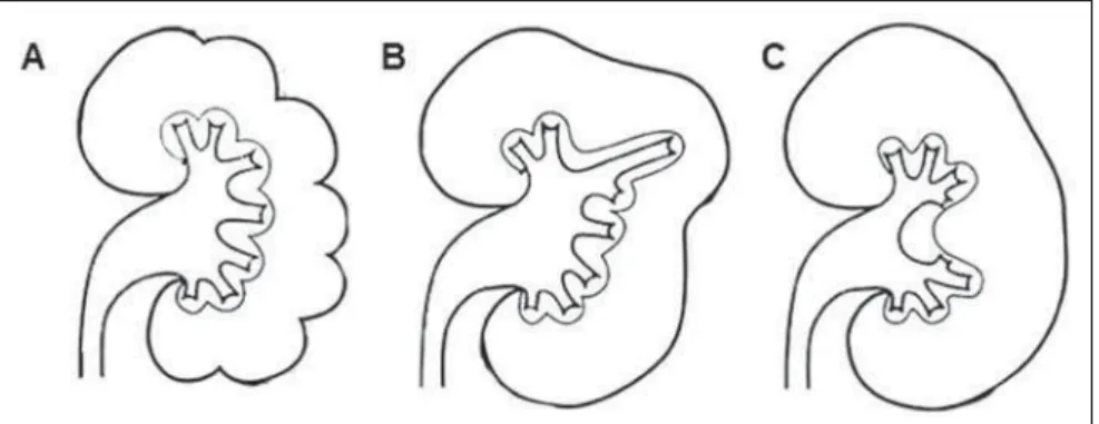 Figure 8. Hypertrophied column of Bertin. Axial (A), coronal (B) and sagittal (C) MDCT images demonstrating septal hypertrophy.