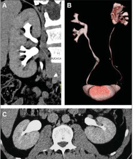 Figure 12. Abnormalities of the renal pelvis. MDCT – coronal (A) and VRT (B) images identifying bifidus pelvis at right