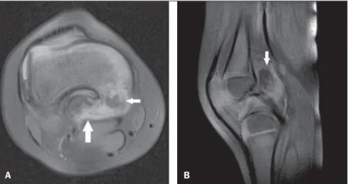 Figure 2. A: Axial MRI proton-density-weighted fat sat image demonstrating involvement of the distal femur by the disease, with irregularities, dysplastic alterations (small arrow), calcifications and  intra-ar-ticular ossification (large arrow)