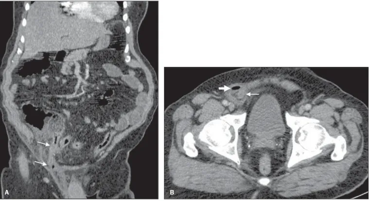 Figure 1. A: Abdominal computed tomography, coronal reconstruction. B: Axial section at the level of the pelvis.
