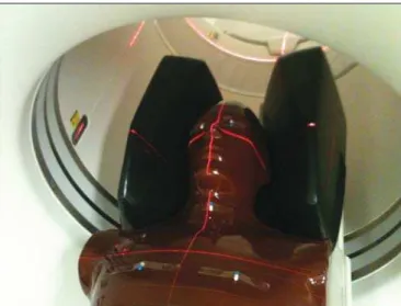 Figure 1 shows the anthropomorphic phantom positioned in the gantry for the performance of the tomography  proce-dure, where one can observe five capsules positioned in the region of the breasts, thyroid and crystalline.