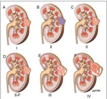 Figure 1. Illustration demonstrates the main findings in the Bosniak classifica- classifica-tion for renal cystic lesions
