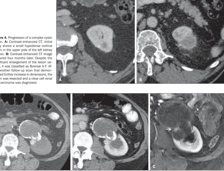 Figure 5. Evaluation of contrast enhancement at CT and MRI. A: Pre- and post-contrast, axial CT sections shows complex cyst with irregular walls and gross, parietal calcifications in the central region of the lesion