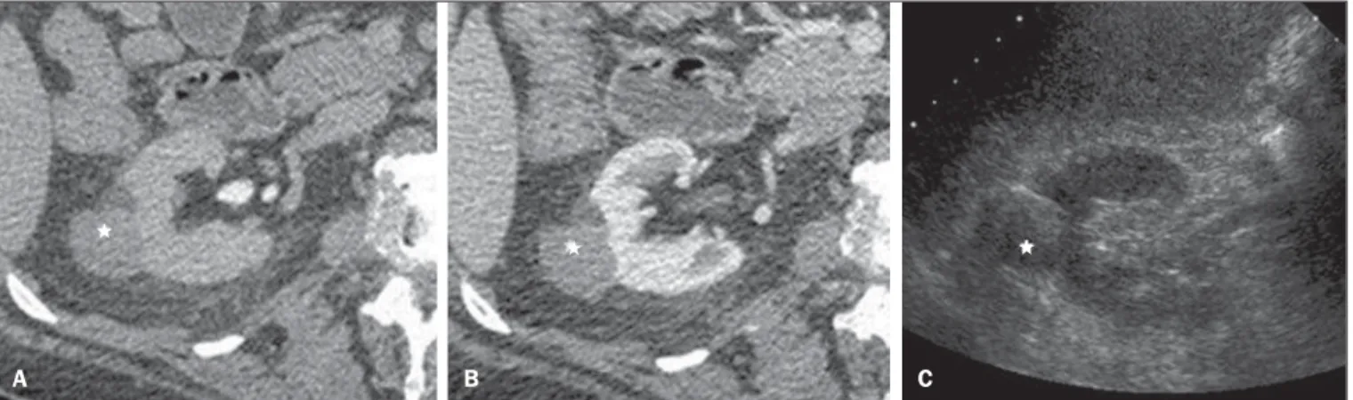 Figure 8. MRI and diffusion-weighted imaging (DWI). A: Axial T2-weighted image shows the presence of septa and solid contents on the anterior wall of the lesion (arrow)