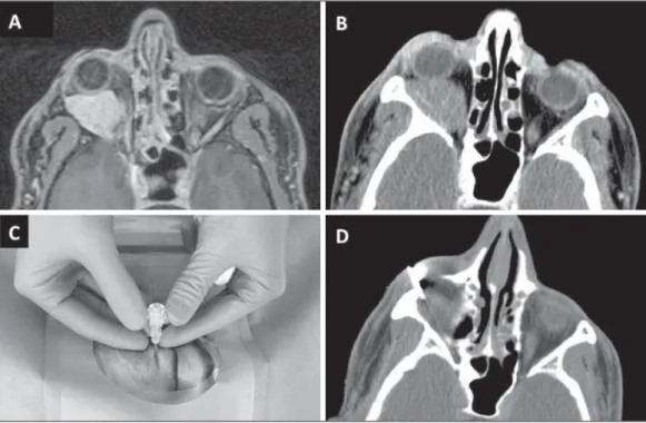 Figure 2. Case 2 – A 32-year-old patient with an orbital lesion at right.