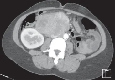 Figure 1. Contrast-enhanced, axial abdominal CT image demonstrating the pres- pres-ence of a heterogeneously enhanced, large slightly lobulated mass in close  con-tact with the IVC, and a small intraluminal component.