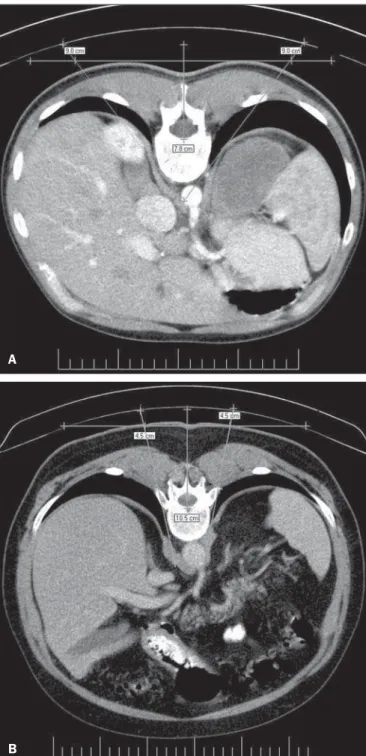 Figure 1. A: Needle insertion pathway 9.0 cm to the right of the midline, indicat- indicat-ing transfixion of lungs