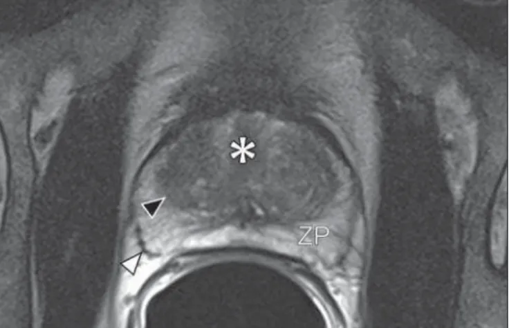 Figure 1. MR imaging of the normal prostate. T2-weighted sequence in the axial plane showing the prostate capsule (white arrowhead), the peripheral zone (ZP), the surgical capsule (black arrowhead) and internal gland (asterisk).