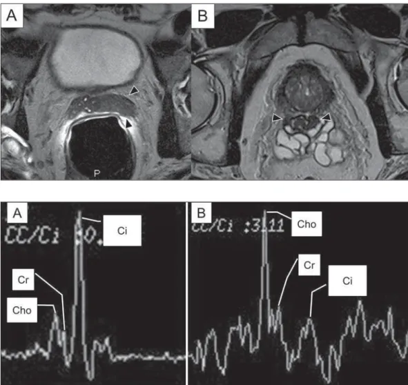 Figure 6. Examples of MRSI pros- pros-tate spectra. A: Typical spectral analysis of normal prostate tissue, showing a high citrate (Ci) peak, with a low choline (Cho) peak, and the peak of creatine (Cr) used as comparison parameter for the other metabolite