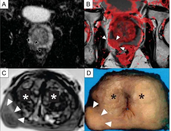 Figure 10. Detection of PCa with DWI.
