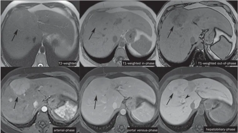 Figure 1. Female, 40-year-old patients presenting with liver steatosis and multiple, well-defined focal hypervascular lesions, with intermediate signal intensity on T2- T2-weighted sequence, with poor lesion-organ contrast-enhancement