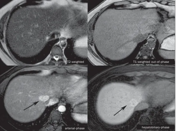 Figure 2. Female, 36-year-old, asymptomatic patient presenting with a hypervascular liver nodule to be clarified, without intralesional fat and without central scar.