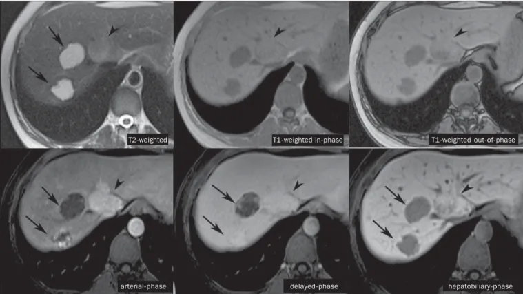 Figure 4. Female, 50-year-old patient with liver nodules to be clarified. The caudate lobe lesion (arrowheads) presents subtle hypersignal on T2-weighted sequence and signal loss on T1-weighted out-of-phase sequence caused by the presence of intralesional 