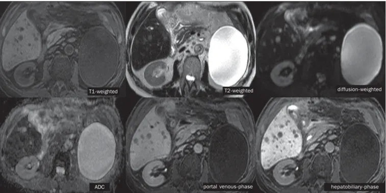 Figure 7. Male, 70-year-old patient presenting with colon cancer and multiple metastases, with hyposignal on T1-weighted, and subtle hypersignal on T2-weighted sequence