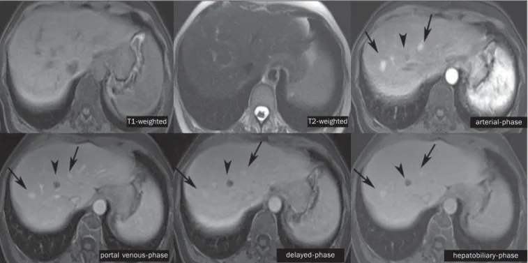 Figure 8. Female, 53-year-old patient presenting with colon cancer. Two hypervascular lesions (arrows) are seen with intermediate signal intensity on T1- and T2- T2-weighted sequences, showing contrast uptake in the hepatobiliary-phase