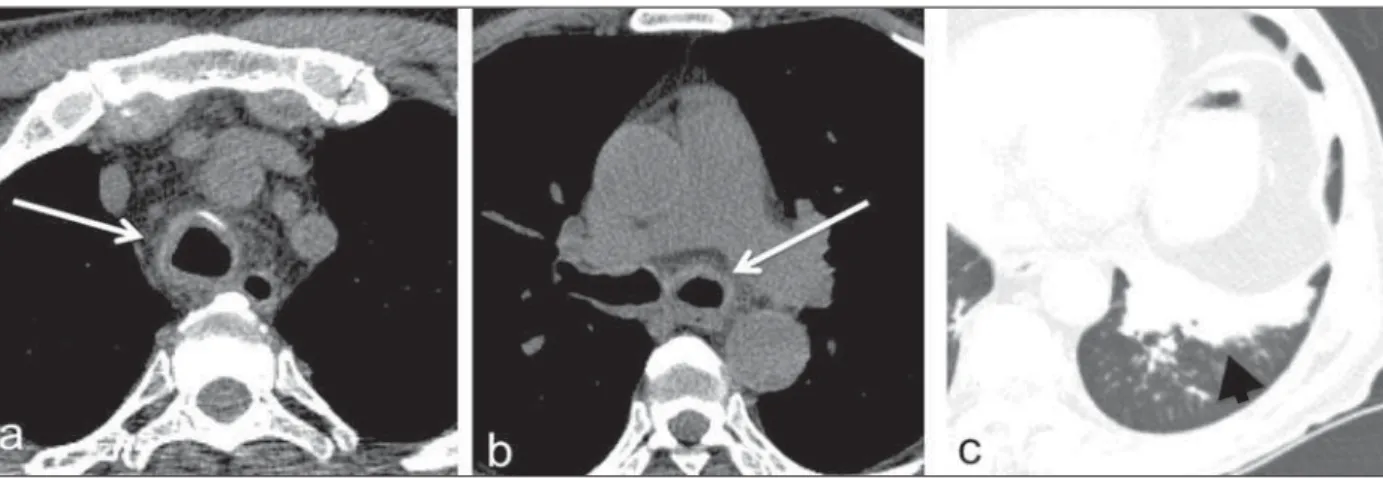Figure 1. Non contrast-enhanced chest CT, axial sections. a: Mediastinal window – subtle tracheal thickening (arrow) associated with slight densification of the adjacent mediastinal fat