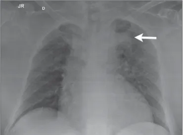 Figure 1. Frontal chest radiographic image demonstrating opacity in the left upper lobe, adjacent to the aortic arch (arrow).