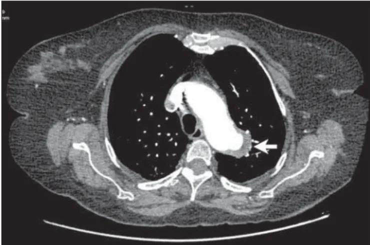 Figure 4. Contrast-enhanced computed tomography, arterial phase showing saccular dilatation with 2.6 cm in diameter on the posterolateral aspect of the aortic arch (arrow), filled by contrast agent and in communication with the aortic lumen, in association