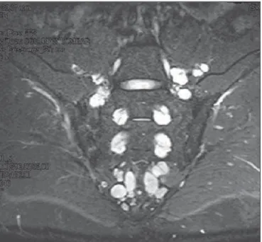 Figure 3. Magnetic resonance imaging demonstrating multiple nodular, string- string-shaped lesions distributed along the nerve roots of the sacral plexus, in the  perivas-cular retroperitoneum, adjacent to the obturator muscles and in the periprostatic neu