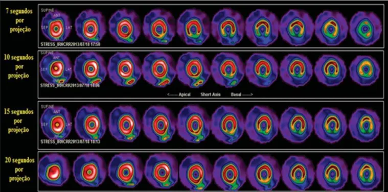 Figure 3. Processed images of the heart phantom with a lesion in the inferobasal segment, with times varying between 7 and 20 seconds per projection, highlighting that the protocol’s standard time is 15 seconds.