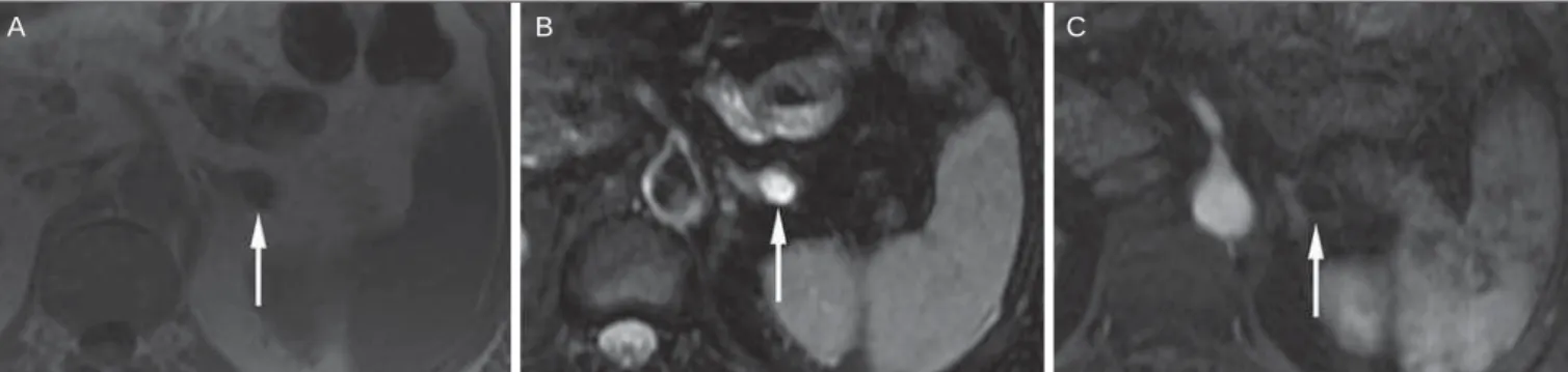 Figure 6. Adrenal cyst. A small unilocular cyst is identified in the left adrenal gland (arrows)