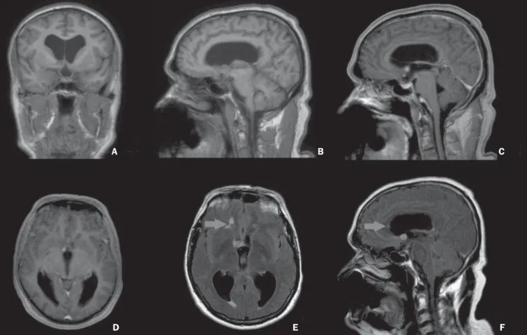 Figure 7. A male, 54-year-old patient. Coronal (A) and sagittal (B) MRI T1-weighted sequence demonstrating the presence of homogeneous, solid nodular lesions with isosignal in relation to the cerebral parenchyma, located in the right Monro’s foramen, with 