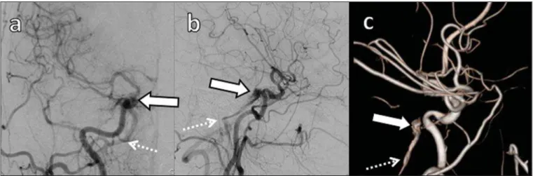 Figure 8. Digital subtraction cerebral angiography, arterial phase. a: Lateral view.