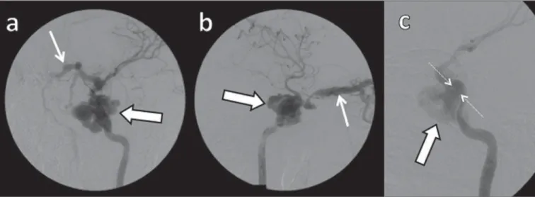 Figure 10. Digital subtraction cerebral angiography, arterial phase. a: Left anterior oblique view