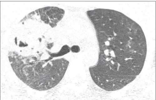 Figura 1. Tomografia computadorizada com janela para parênquima pulmonar. Corte ao nível da carina.