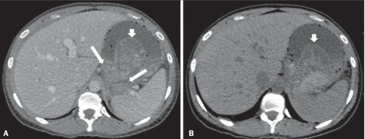 Figure 9. Pseudocyst in acute pancreatitis. A,B: Contrast-enhanced axial CT image, venous phase showing acute inflammatory changes in the pancreatic tail (long arrows on A) and pseudocyst with spontaneously hyperattenuating hematic content (short arrows on