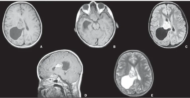 Figure 4. Female, 10-year-old patient. Axial MRI T1-weighted sequences (A) demonstrate the presence of a solid-cystic lesion located in the right lateral ventricle, with solid component presenting isosignal and cystic component with hyposignal