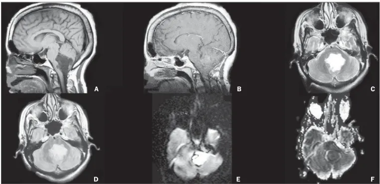 Figure 7. Female, 67-year-old patient. Pre-contrast axial CT (A) and post-contrast axial CT (B,C) demonstrate spontaneously hyperdense, lobulated lesion with intense contrast uptake