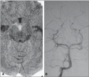 Figure 6. Perimesencephalic hemorrhage. Spontaneously hyperdense hematic material at the level of the interpeduncular cistern (non-contrast-enhanced  com-puted tomography – image on A)