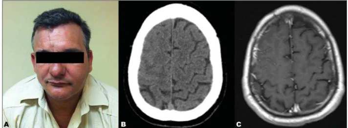 Figure 1. A: Right hemifacial alteration characterized by remarkable atrophy and deformity