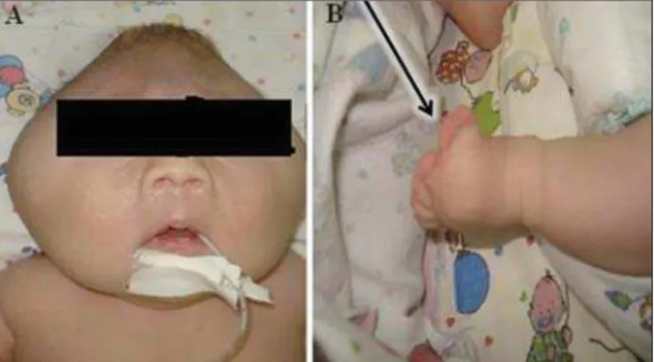 Figure 1. A: Demonstration of typical craniofacial alterations. B: Syndactyly (arrow).