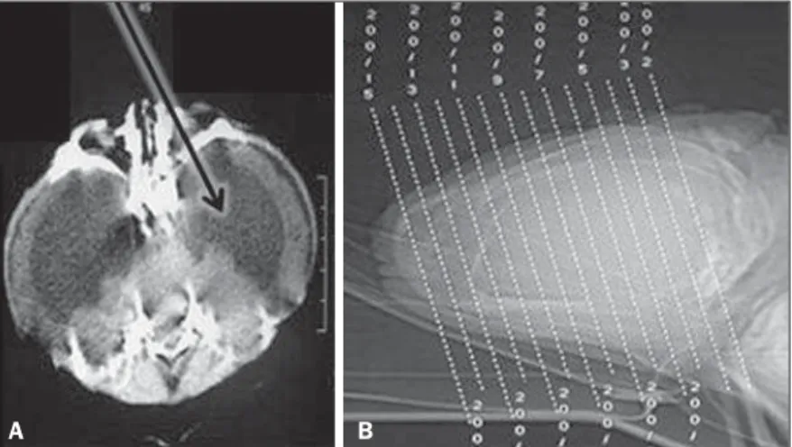 Figure 3. A: Trilobed aspect of the skull, with hydrocephalus and bulging of the middle fossae (arrow)