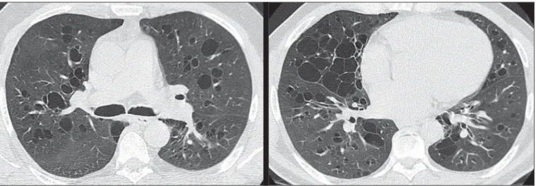 Figura 1. Tomografia computadorizada de alta resolução, com cortes nas regiões pulmonares médias e inferiores.