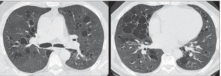 Figure 1. High resolution computed tomography with sections of the middle and lower pulmonary regions.