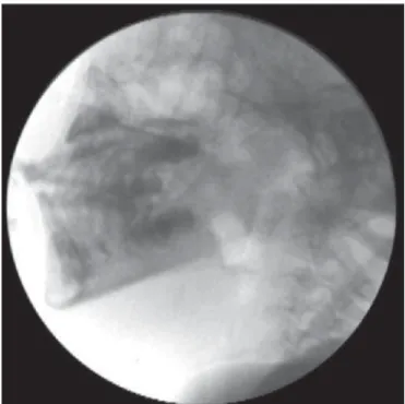Figure 1. Fluoroscopic image of a child with chronic encephalopathy of child- child-hood.