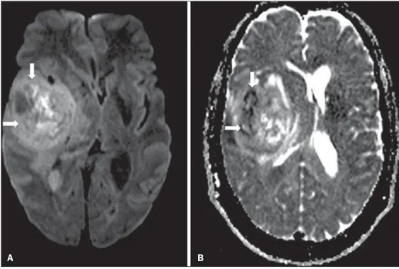 Figure 3. Diffusion-weighted images with different b values from a 47 year-old female patient presenting with liver hemangioma in the transition between the V and VI segments