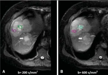 Figure 4. Liver metastases in a 66-year-old female patient presenting with colon adenocarcinoma, undergoing treatment with antiangiogenic drug bevacizumab.