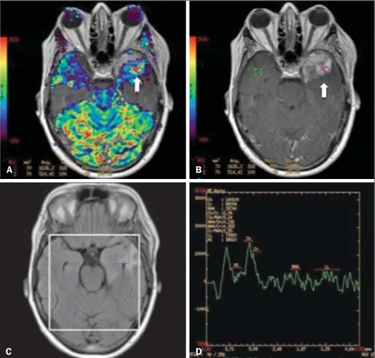 Figure 8. A 55-year-old male patient. Tumor resection (glioblastoma multiforme) in the left temporal lobe six months ago, undergoing  treat-ment with radiotherapy and temodal