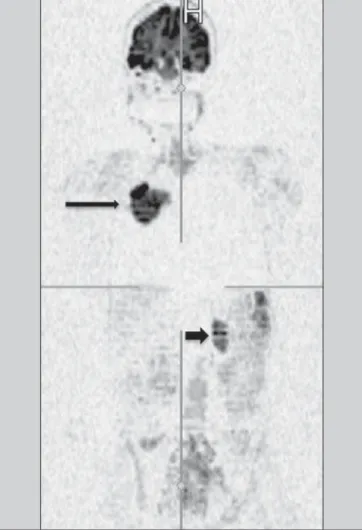 Figure 10. WBMRI is useful in the detection of metastases, particularly in brain, liver and bone lesions